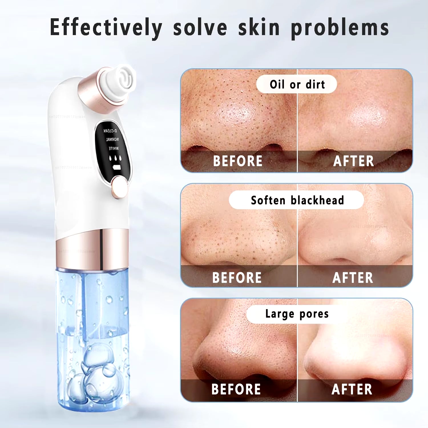Professional Water-Cycle Blackhead Remover & Pore Vacuum – USB Rechargeable Deep-Cleansing Acne Treatment Device